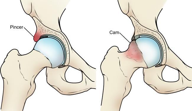 types of femoroacetabular impingement