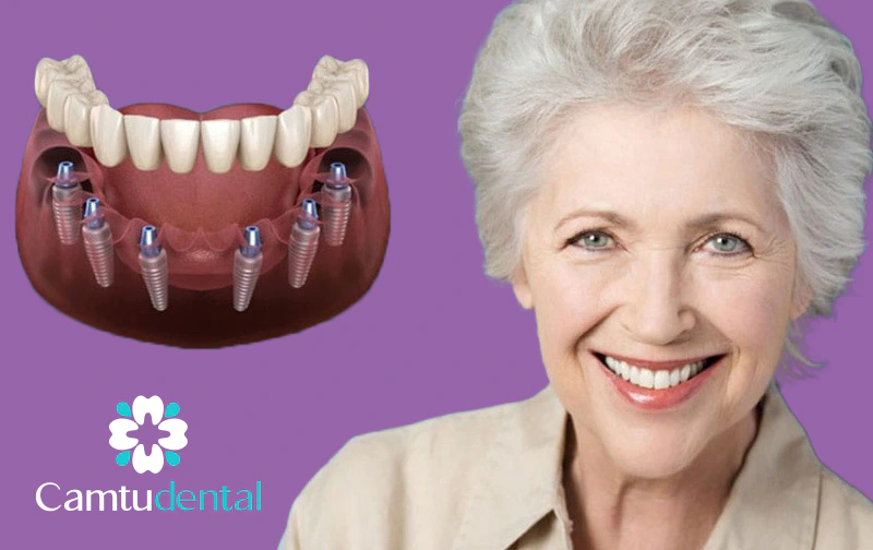 một người phụ nữ lớn tuổi rạng rỡ khoe nụ cười hoàn hảo bên cạnh hình minh họa về cấy ghép Implant all-on-6