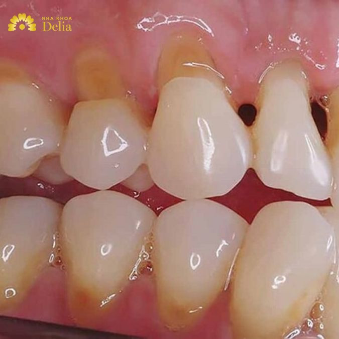 Việc men răng bị yếu rất dễ khiến ngà răng bên trong bị lộ ra ngoài