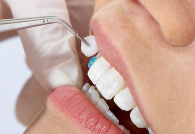  Công dụng của keo dán răng sứ là giúp cố định mão sứ trên cùi răng thật