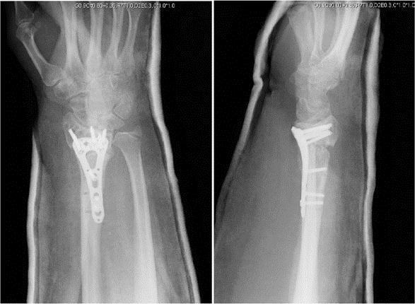 http://www.ispub.com/journal/the-internet-journal-of-orthopedic-surgery/volume-19-issue-2/non-union-of-fractured-distal-radius-treated-with-a-volar-locking-plate-a-case-report.article-g03.fs.jpg