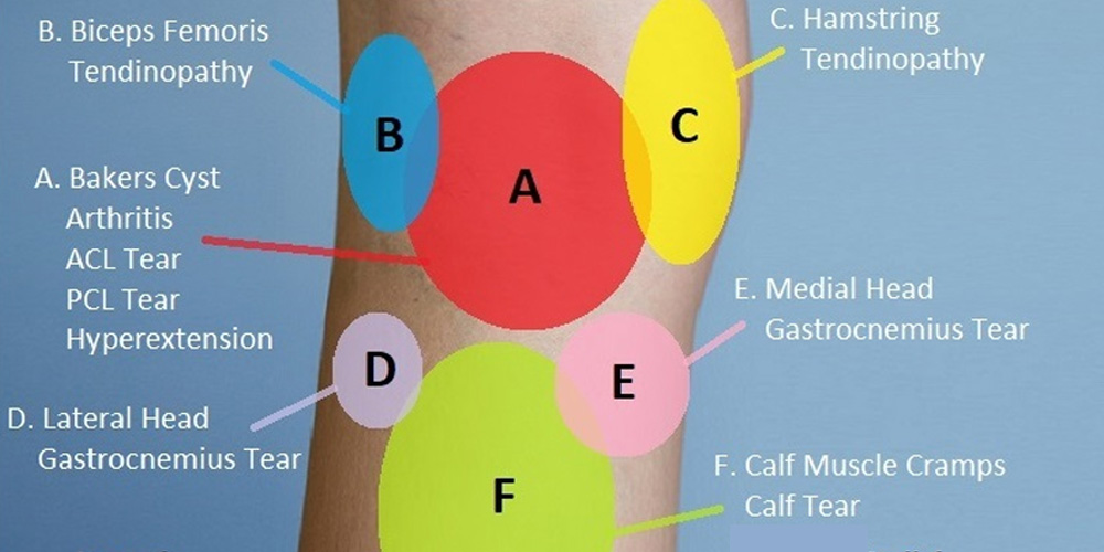 knee-pain-location-chart-treatment