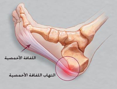 1Plantar fasciitis2.jpg