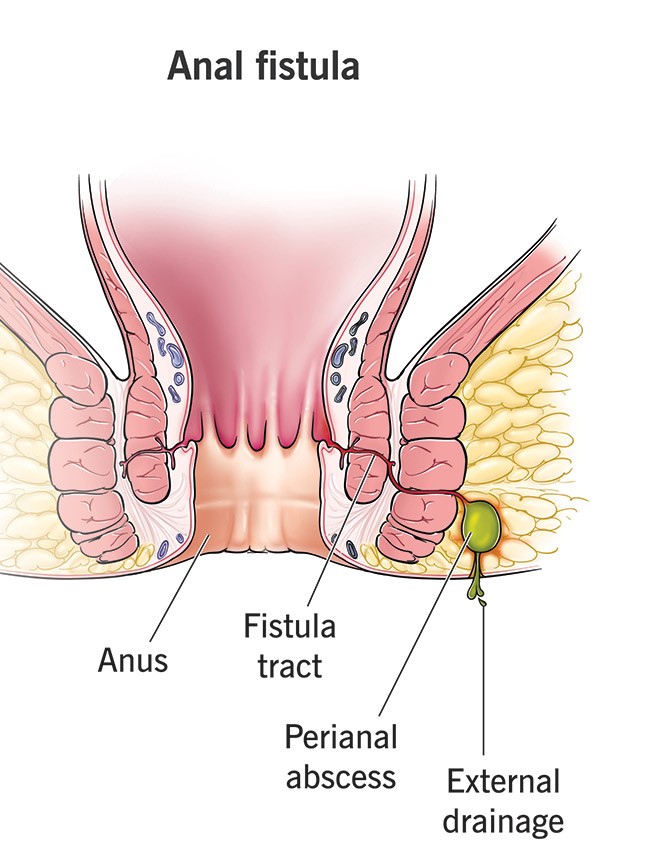 Anal Fistula