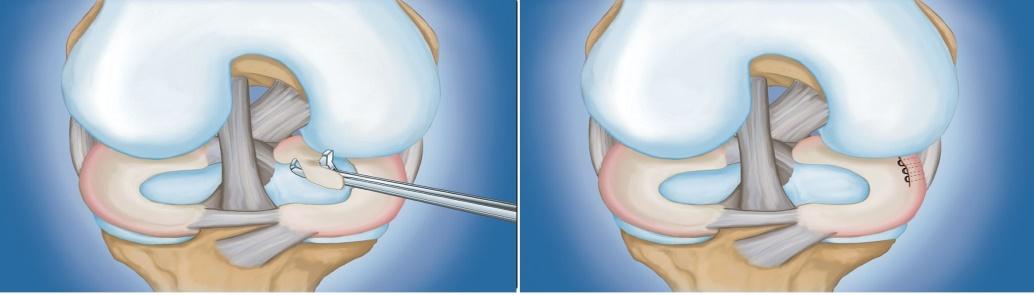 types of arthroscopic procedures for meniscus tears