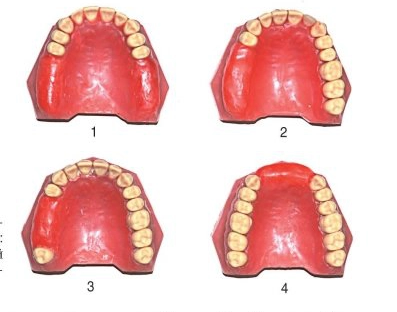 Классификация дефектов зубных рядов по Кеннеди.