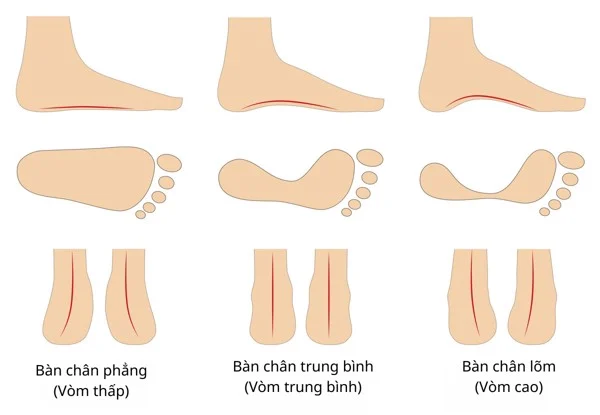 Có ba loại vòm bàn chân chủ yếu: bàn chân có vòm cao, vòm trung bình và bàn chân phẳng