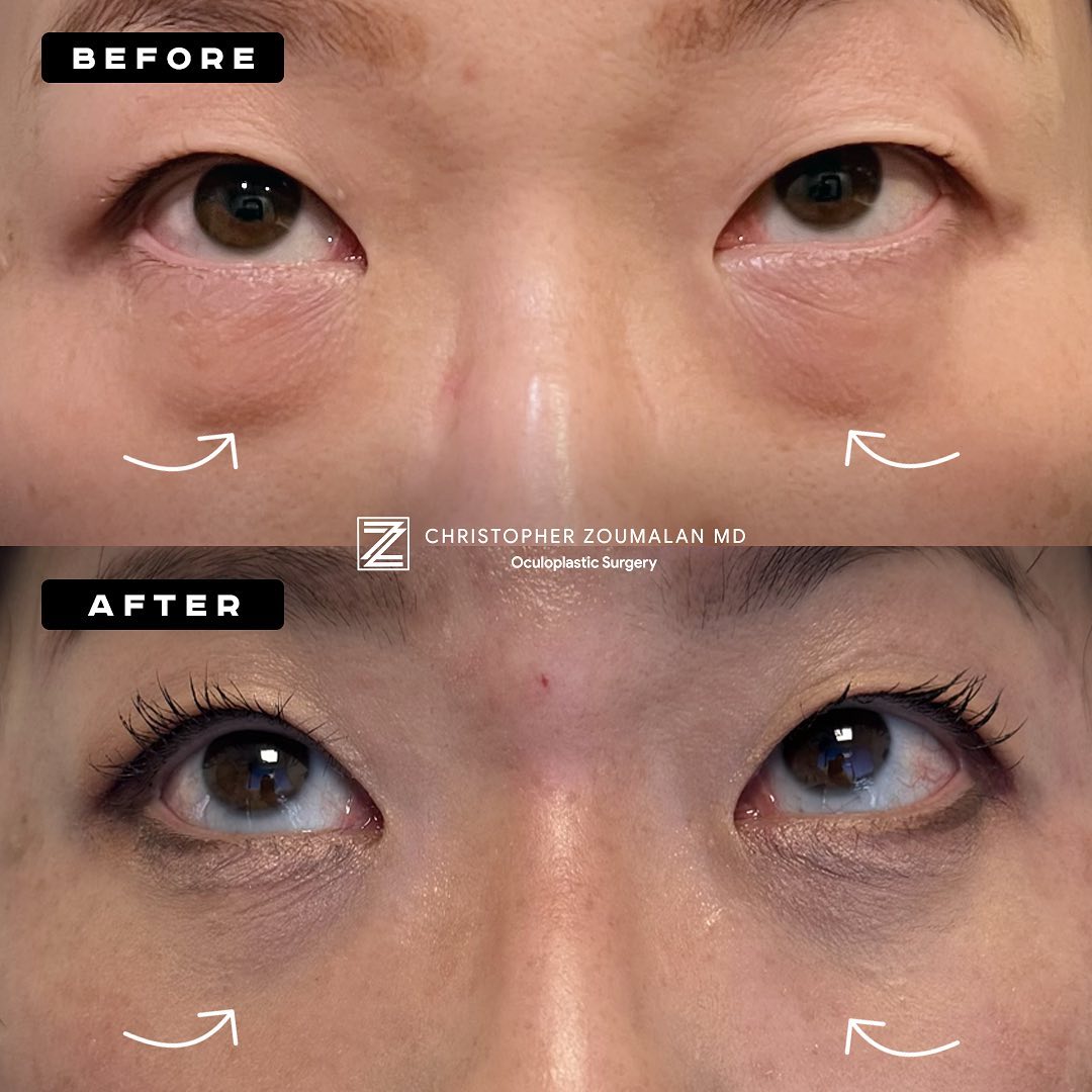 Blepharoplasty Before and After: Stunning Transformations