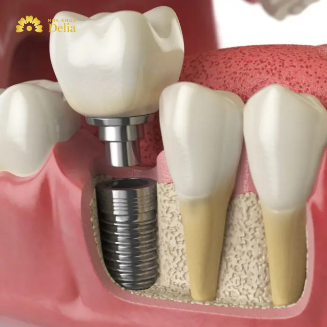 Loạn giá trồng răng Implant tại Việt Nam, lựa chọn dịch vụ ra sao?