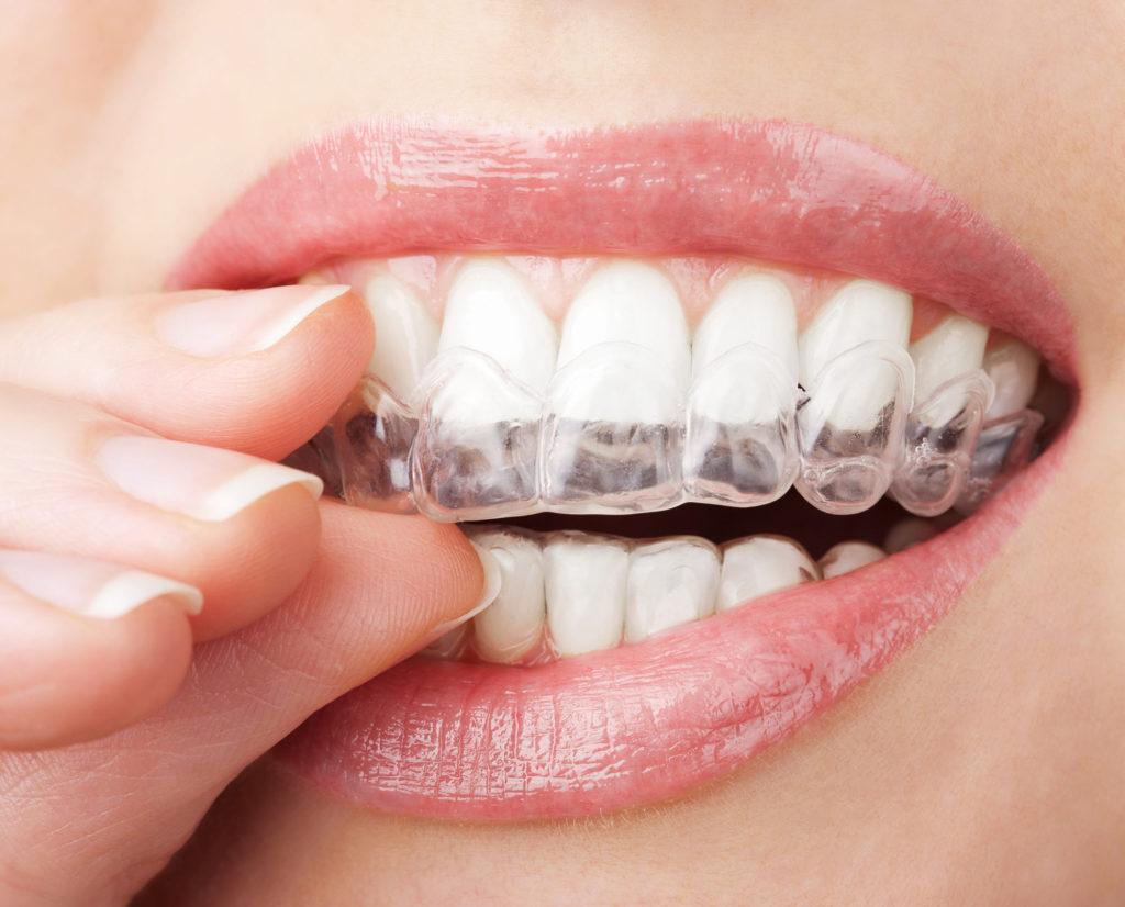 Invisalign in New Westminster