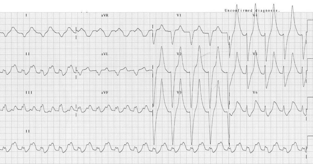 ECG Hyperkalemia serum potassium 9.3