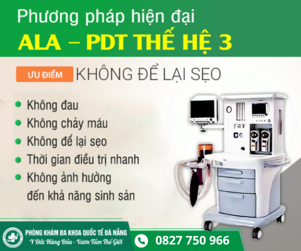 chữa sùi mào gà bằng liệu pháp quang động ala - pdt