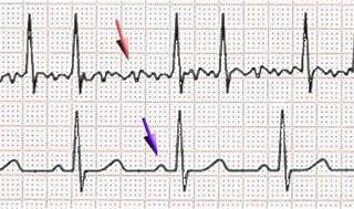 Atrial fibrillation