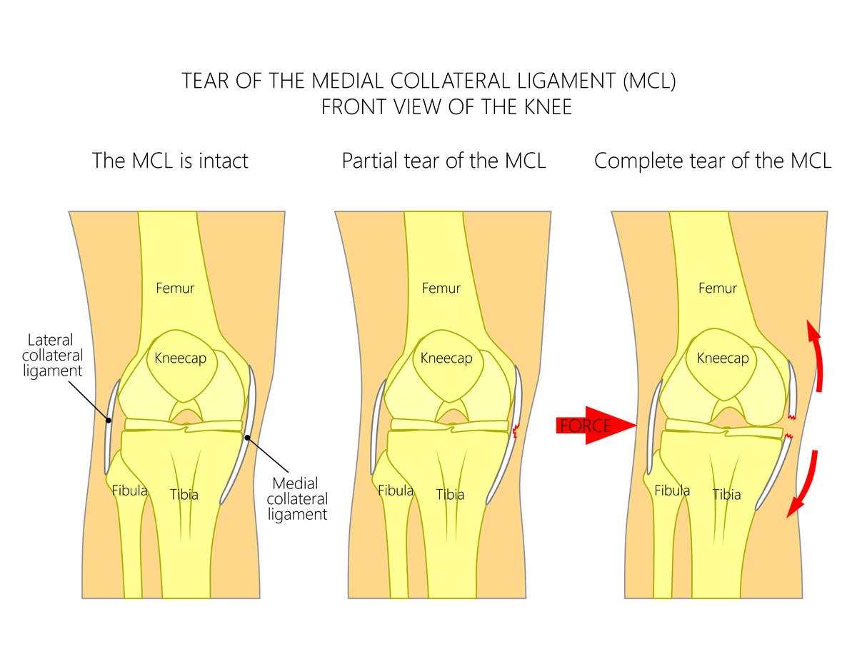 Image result for mcl reconstruction