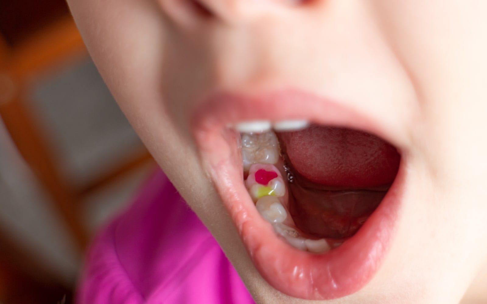 Dental Cavity Filling for Children  