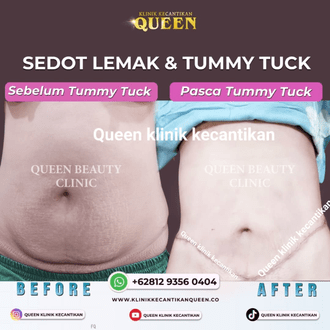 Operasi Sedot Lemak, Manfaat, Harga, Dan Hal Yang Harus Diketahui - KLINIK  BEDAH PLASTIK QUEEN - SOLO