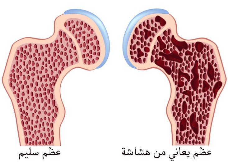 Osteoporosis-bone.jpg
