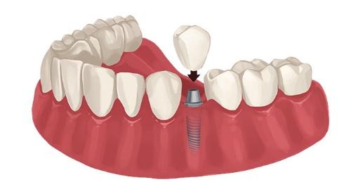 dental implants in Woodbridge