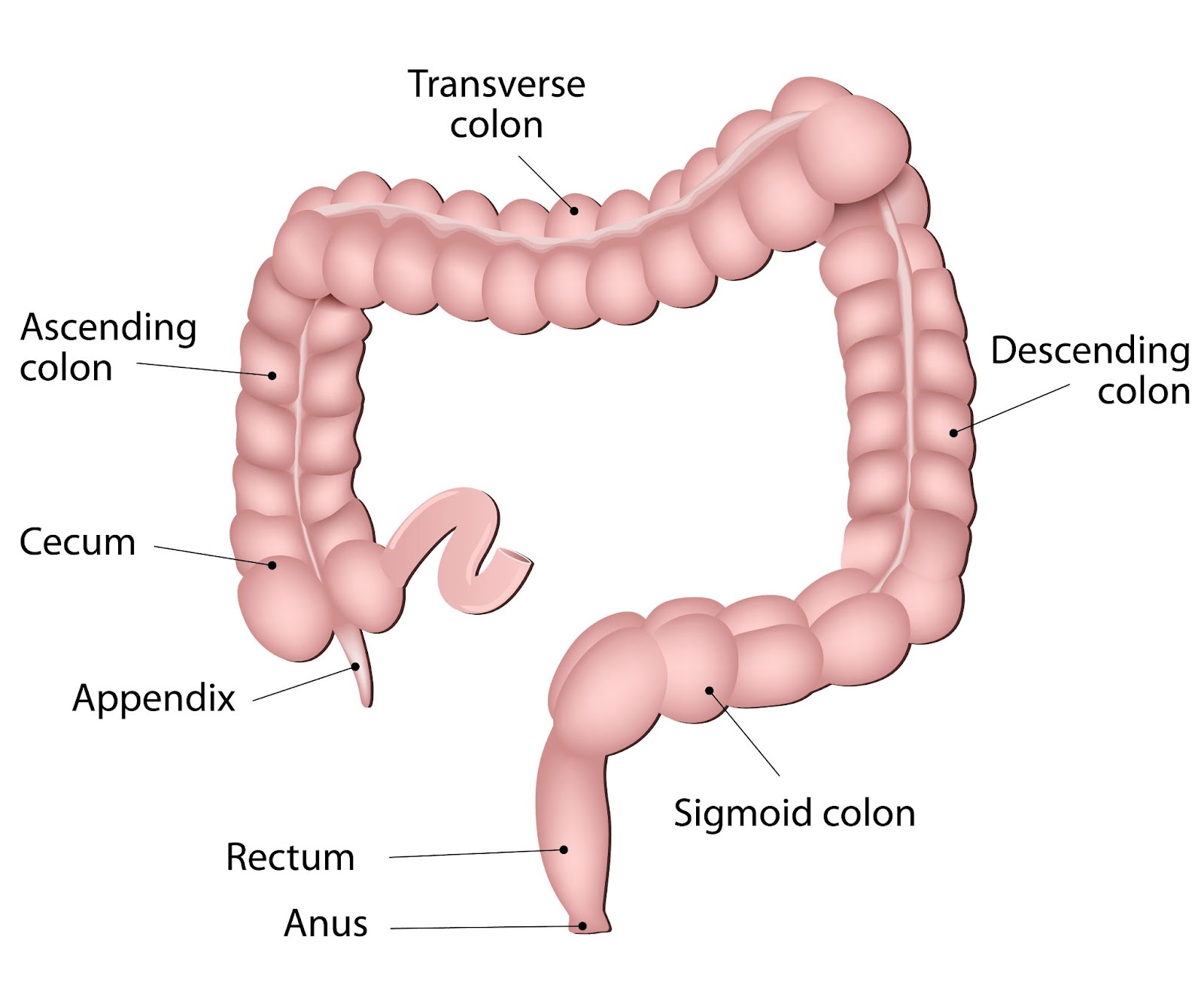 Ulcerative Colitis, UC