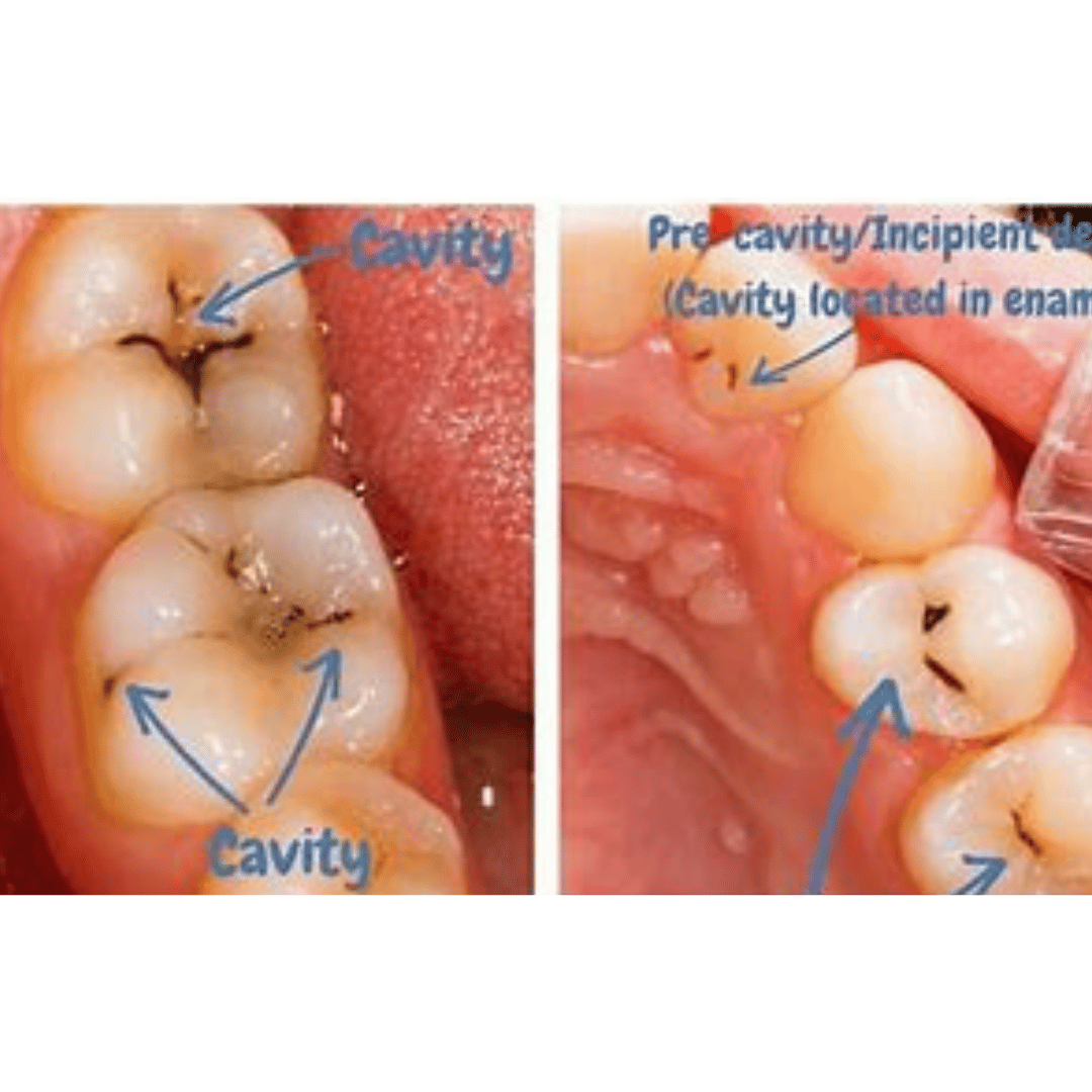 Cavity on Side of Tooth