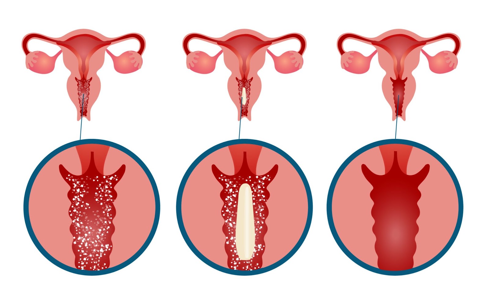 vaginalne probiotika