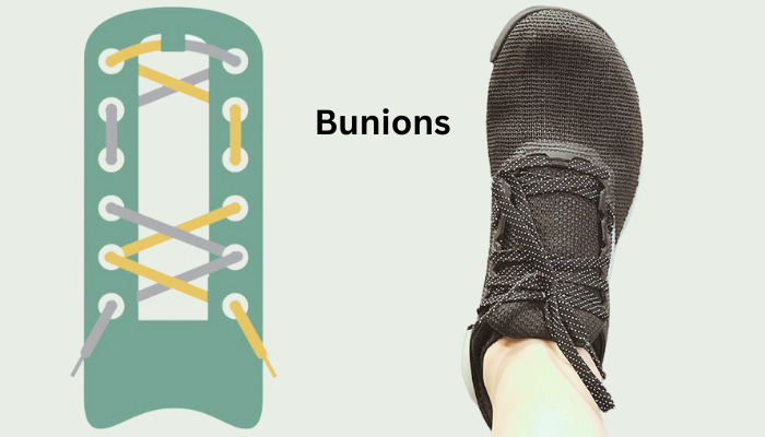 Bunions / Wide ForeFoot