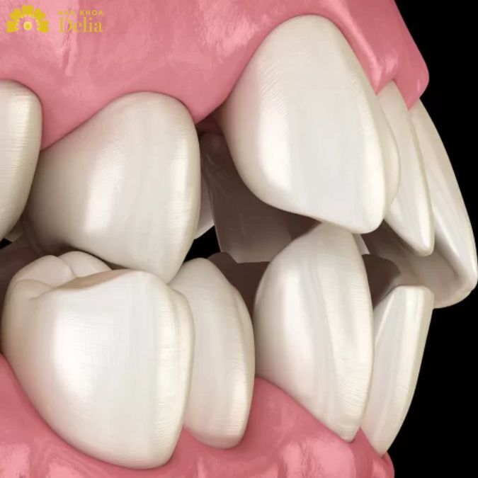 Răng mọc lệch lạc mức độ vừa phải nên cân nhắc bọc răng sứ