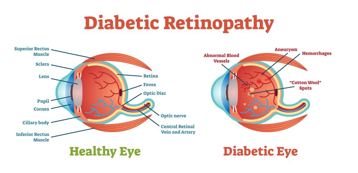 Diabetic Retinopathy: Symptoms, Treatment, Prevention | MyVision.org