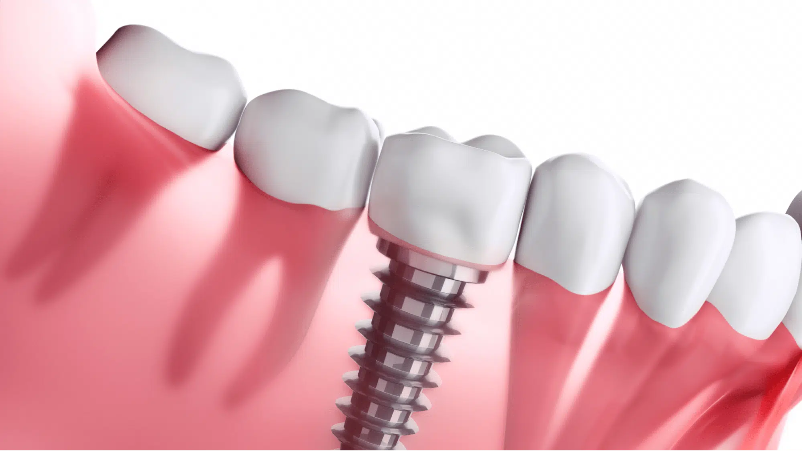 Este Medical Group’s Expertise: Transformative Dental Implants for a Nice Smile in Turkey