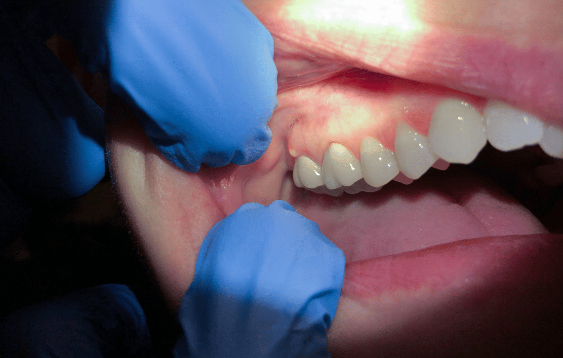 Dentist examining rear teeth