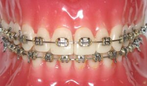 what are Metal braces