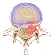 https://www.physio-pedia.com/images/thumb/b/bf/Disc_sequestration.jpg/170px-Disc_sequestration.jpg