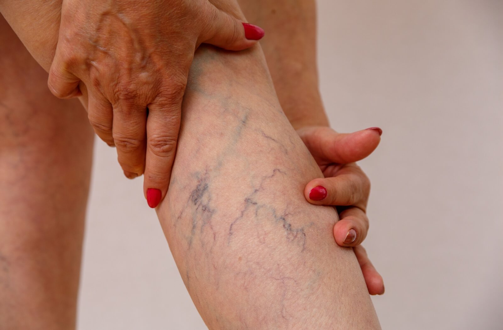 Close-up of an older adult woman's right leg with spider veins