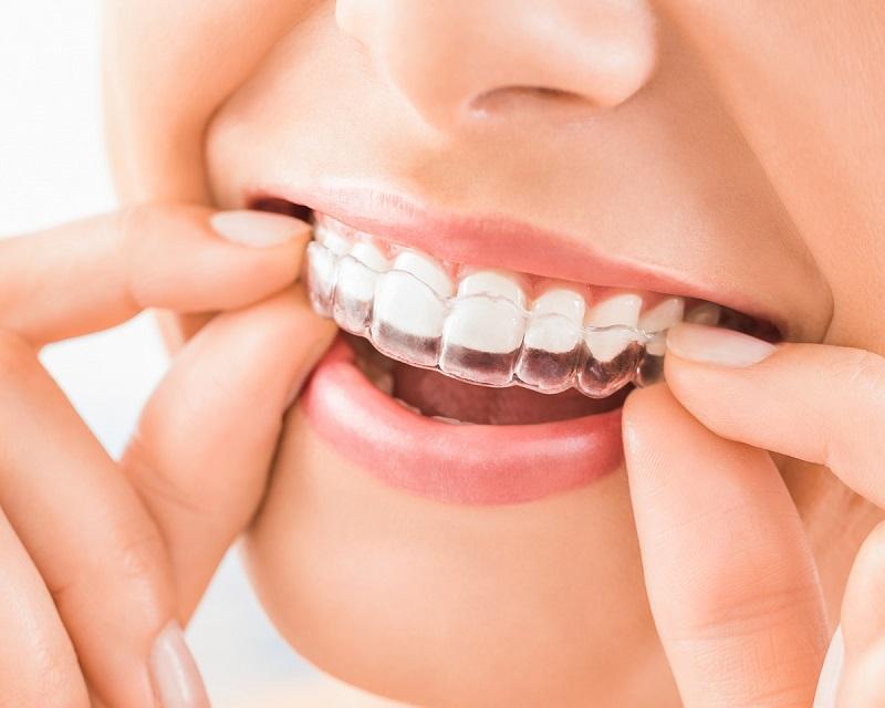 Invisalign treatment in Toronto