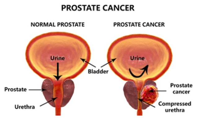 مراحل سرطان البروستاتا 