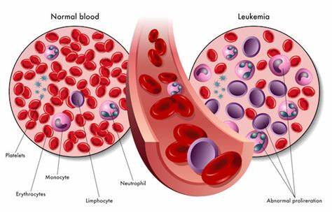 Leukemia