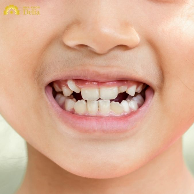 Có rất nhiều nguyên nhân gây ra tình trạng răng lộn xộn