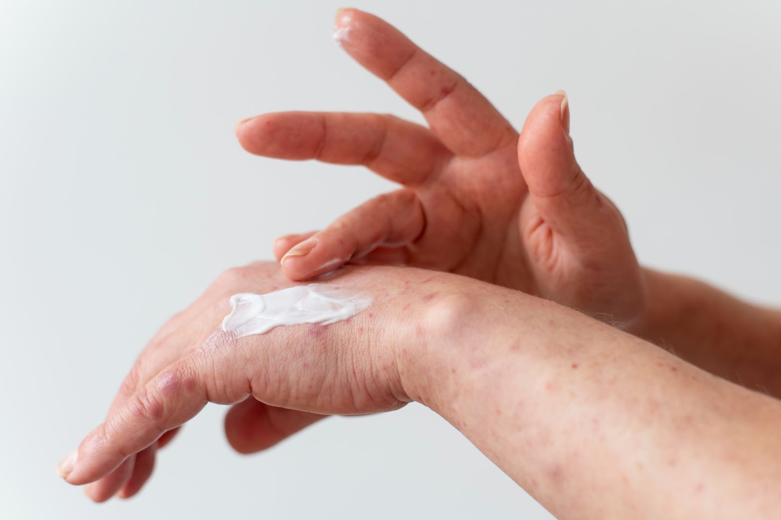 Gestiunea eczemelor în viața de zi cu zi