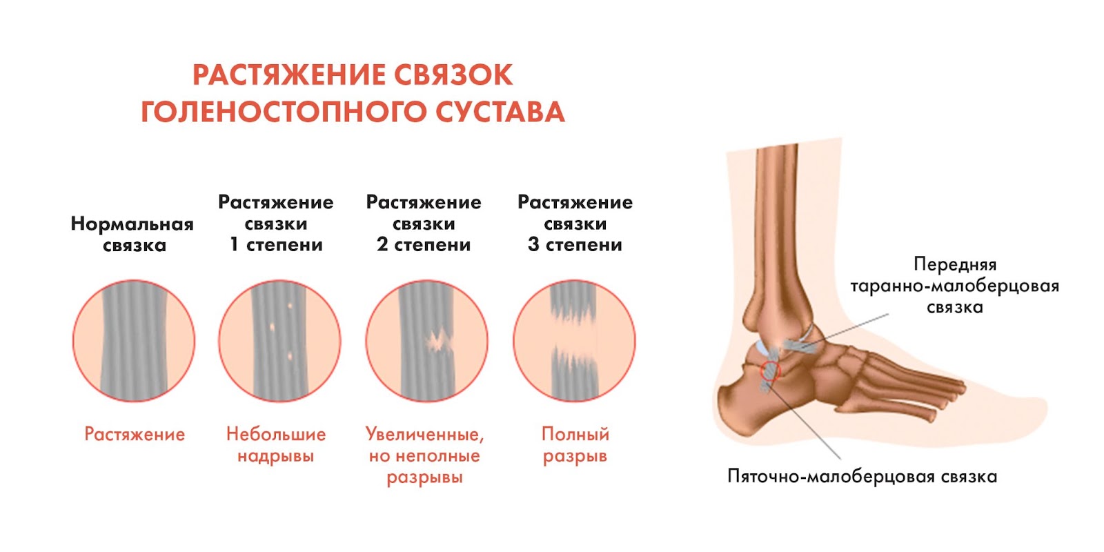 Травмы у бегунов: 6 основных травм