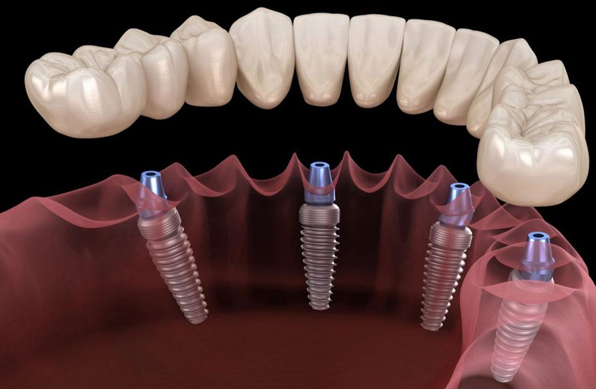  teeth implant clinic in Vancouver