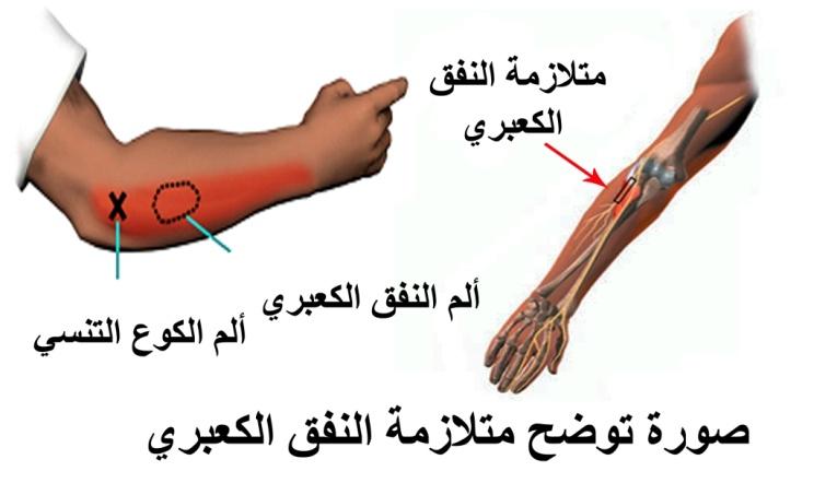 E:\Documents and Settings\USER\Desktop\كبار السن\متلازمة النفق الكعبري.jpg