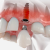Tiêu chuẩn xương hàm trong cấy ghép Implant: Những điều cần biết
