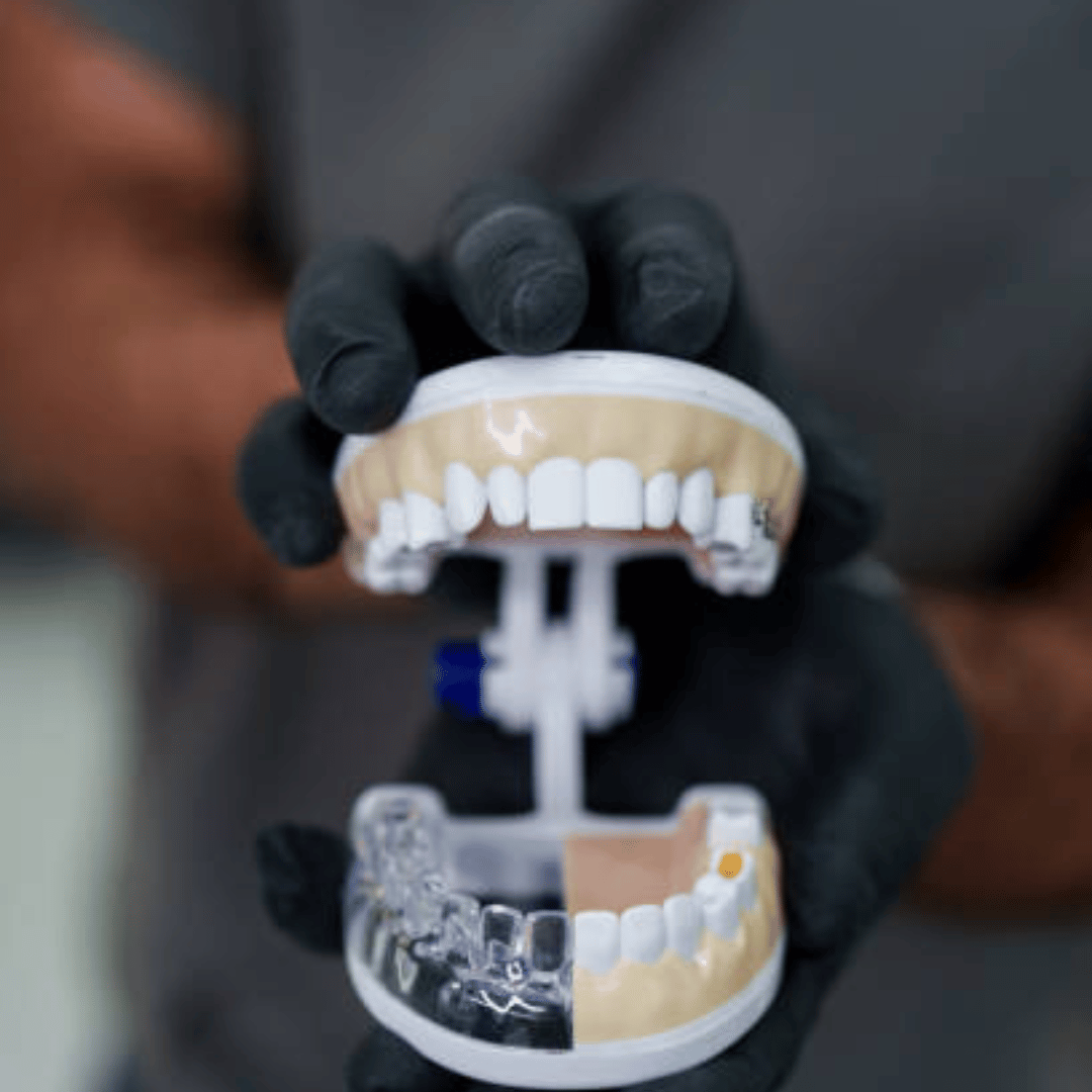 Can You Do Invisalign with a Bridge