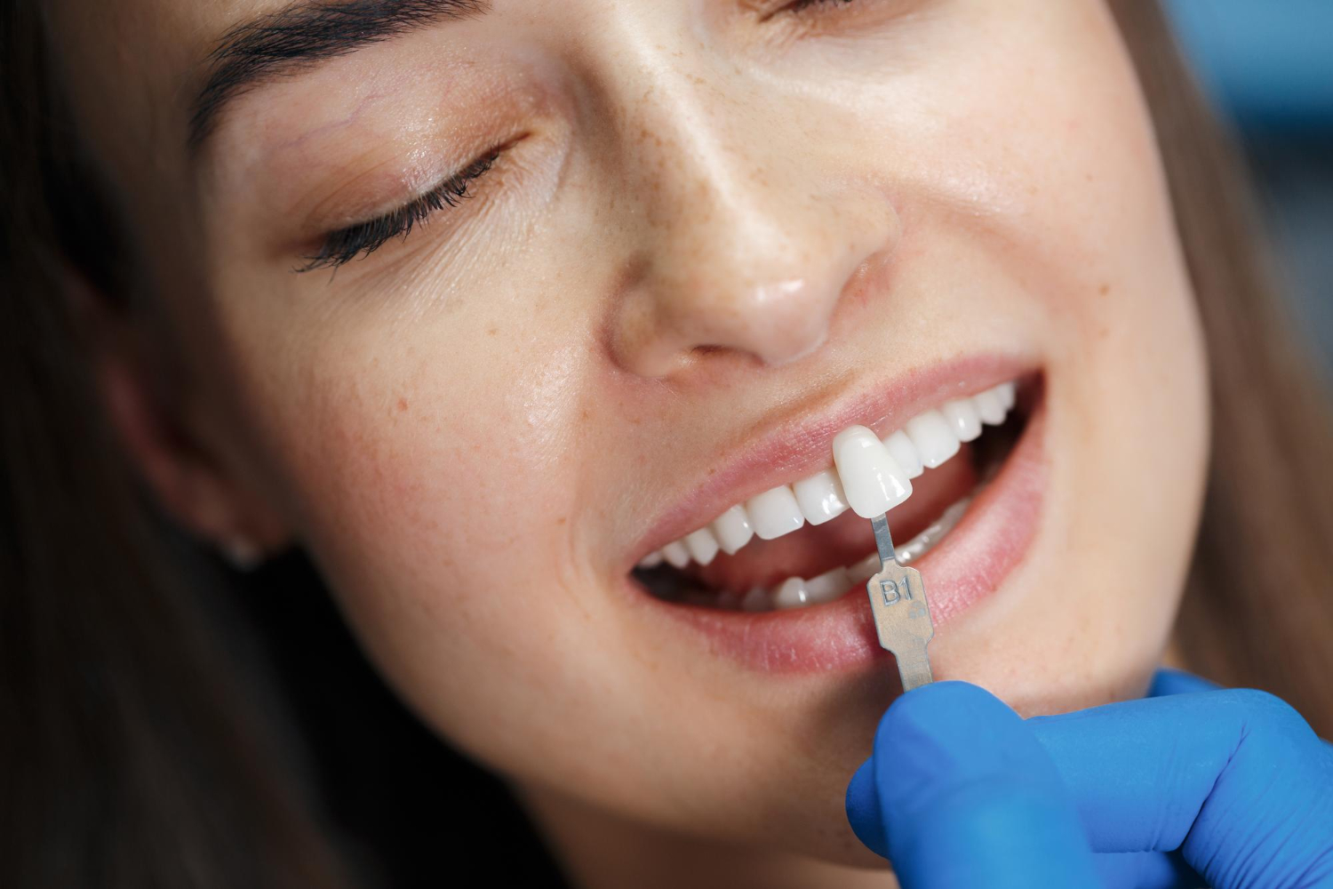 Bọc răng sứ giúp cải thiện tính thẩm mỹ cho hàm răng khá hiệu quả