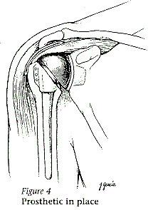 illustration of a shoulder joint prosthetic in place