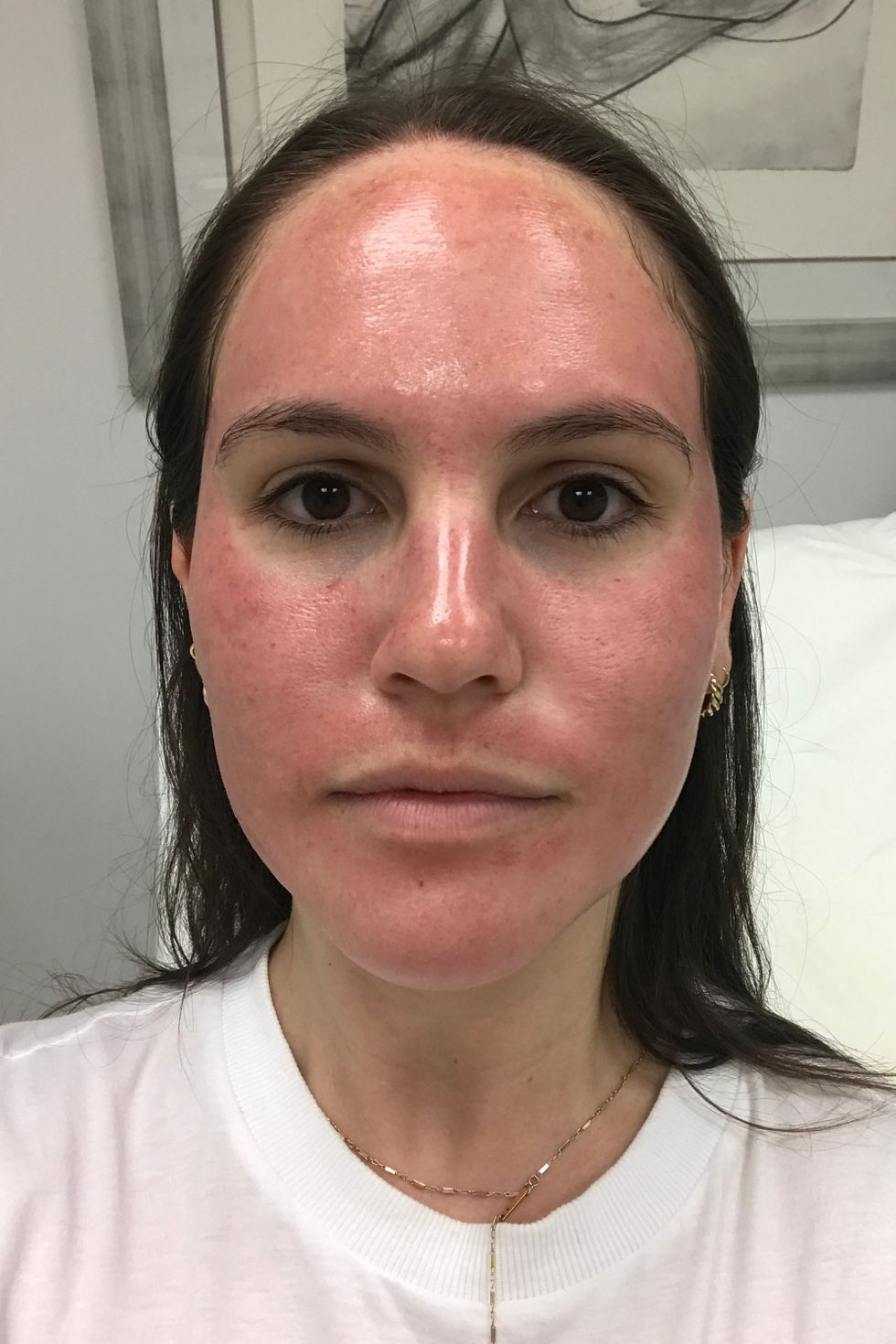 Immediately After Pro Facial
