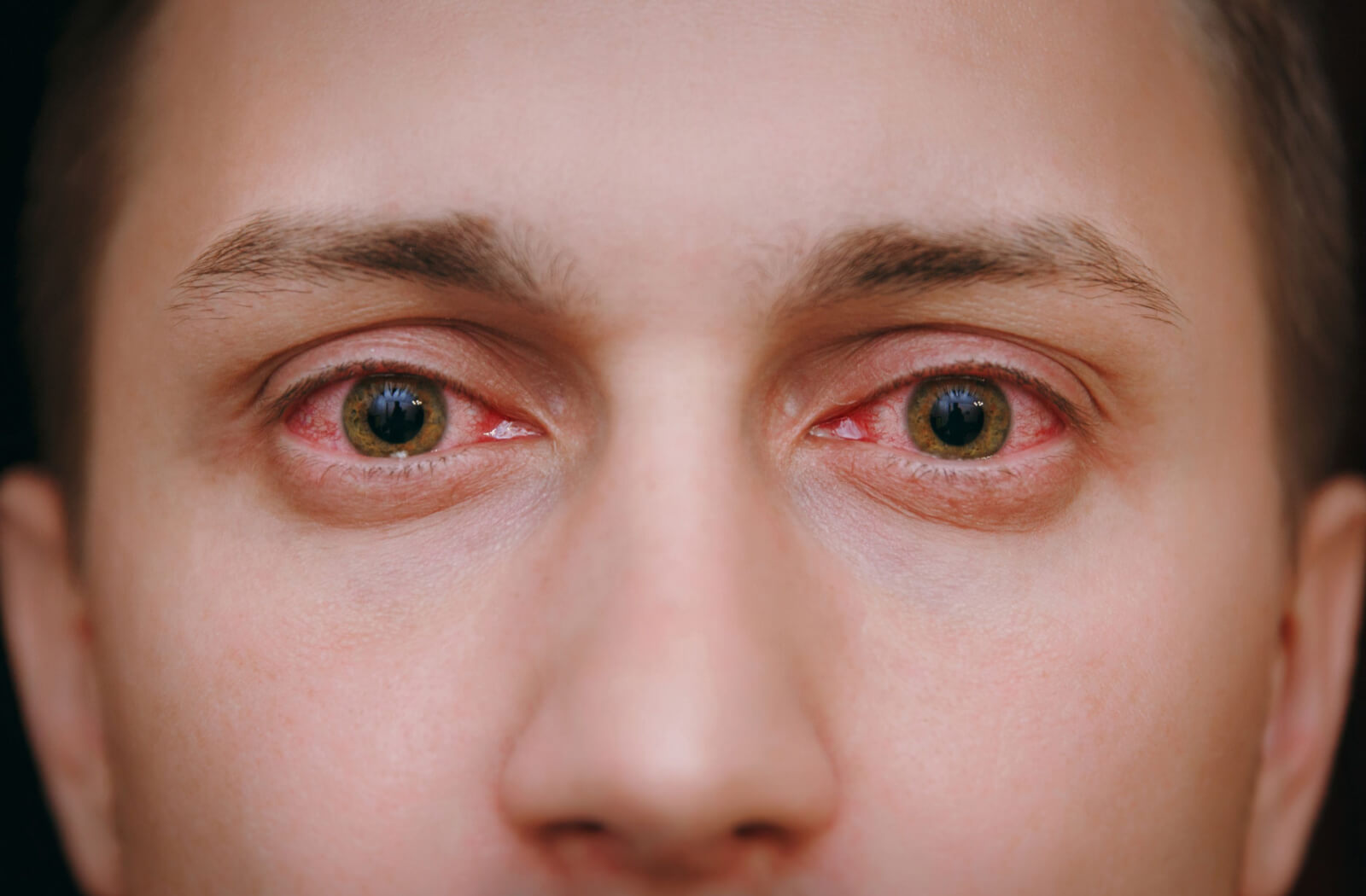 A close-up of blood-shot eyes caused by an infection.