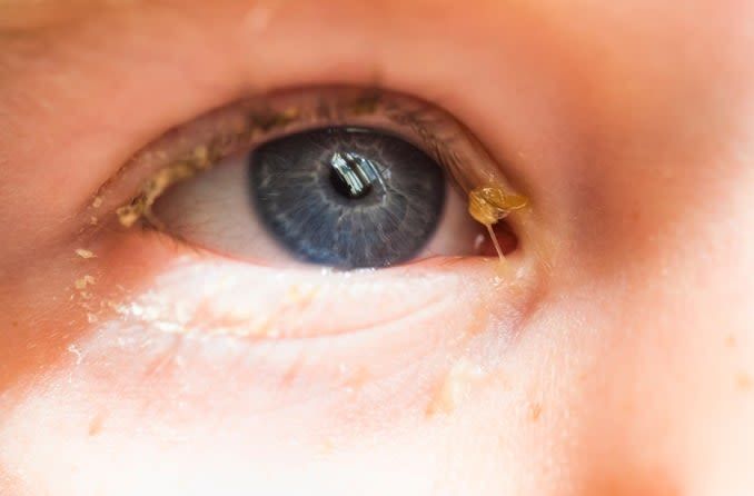 Penyebab Mata Belekan Pada Anak 