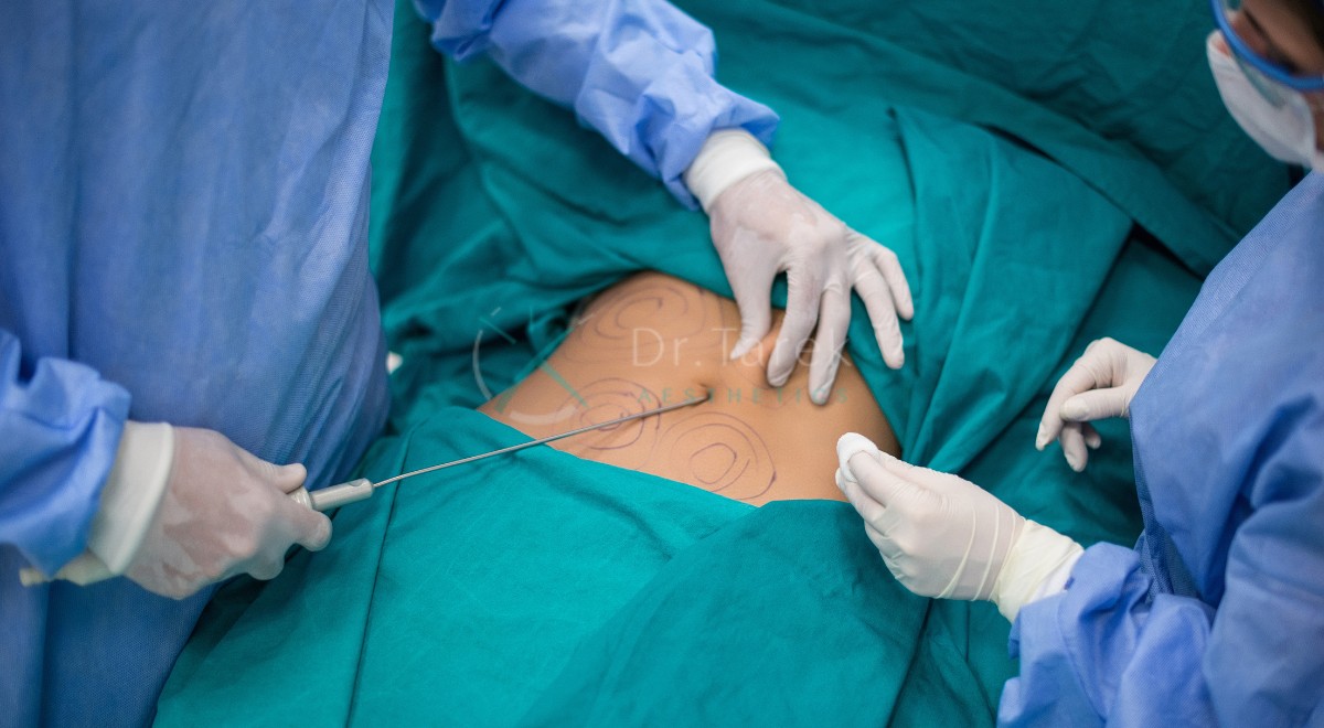 Is Liposuction Good For Weight Loss