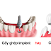 Nên trồng Implant khi mất răng hay tiến hành bọc răng sứ?